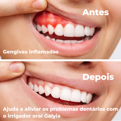 Hidropulsor Oral Profissional – Limpeza Profunda e Higiene Oral